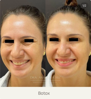 Foto real de um paciente após aplicação de Botox pela Dra. Beatriz Bandeira em Limoeiro do Norte-CE, com suavização de rugas e linhas de expressão.