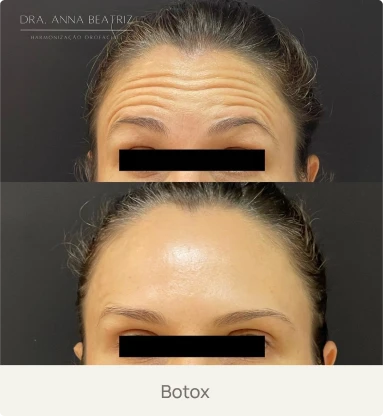 Foto real de um paciente após aplicação de Botox pela Dra. Beatriz Bandeira em Limoeiro do Norte-CE, com suavização de rugas e linhas de expressão.