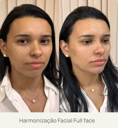 Foto real de um paciente após Harmonização Facial Full Face com a Dra. Beatriz Bandeira em Limoeiro do Norte-CE, mostrando equilíbrio e rejuvenescimento facial.