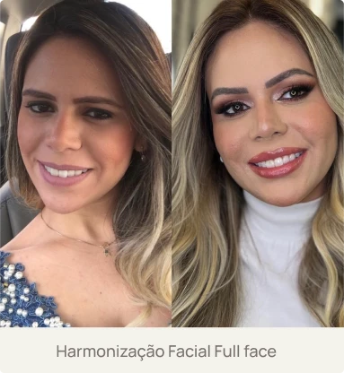 Foto real de um paciente após Harmonização Facial Full Face com a Dra. Beatriz Bandeira em Limoeiro do Norte-CE, mostrando equilíbrio e rejuvenescimento facial.