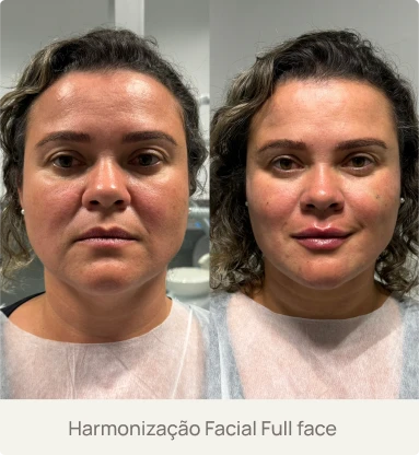 Foto real de um paciente após Harmonização Facial Full Face com a Dra. Beatriz Bandeira em Limoeiro do Norte-CE, mostrando equilíbrio e rejuvenescimento facial.