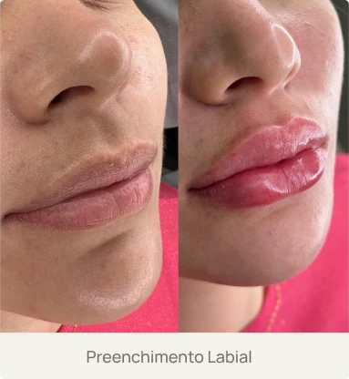 Foto real de um paciente após preenchimento labial com ácido hialurônico pela Dra. Beatriz Bandeira em Limoeiro do Norte-CE, destacando volume e definição dos lábios.