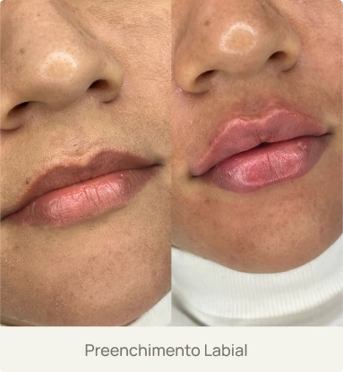 Foto real de um paciente após preenchimento labial com ácido hialurônico pela Dra. Beatriz Bandeira em Limoeiro do Norte-CE, destacando volume e definição dos lábios.