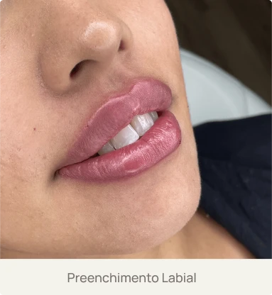 Foto real de um paciente após preenchimento labial com ácido hialurônico pela Dra. Beatriz Bandeira em Limoeiro do Norte-CE, destacando volume e definição dos lábios.