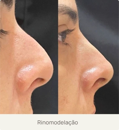 Foto real de um paciente após rinomodelação com ácido hialurônico pela Dra. Beatriz Bandeira em Limoeiro do Norte-CE, evidenciando correção de imperfeições no nariz sem cirurgia.