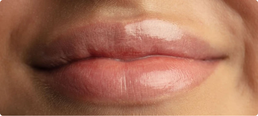 Preenchimento labial em Fortaleza: Resultado imediato?
