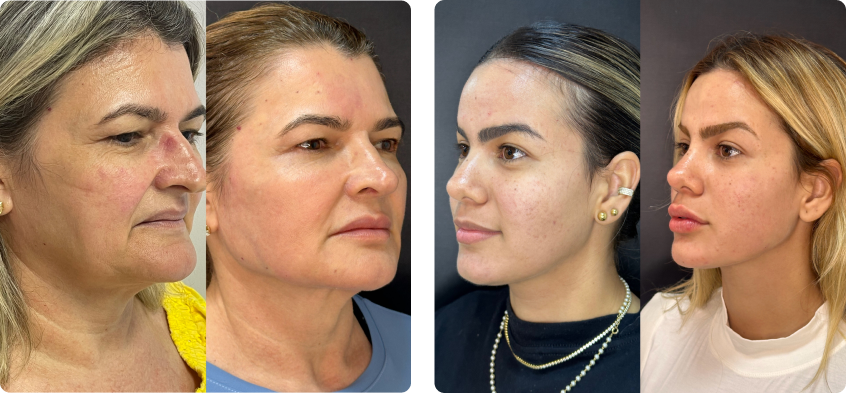 Antes e depois de harmonização facial em Fortaleza.