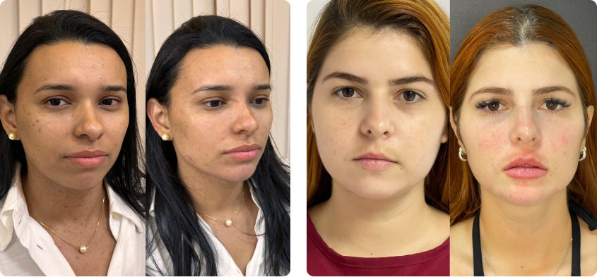 Antes e depois de harmonização facial em Fortaleza.