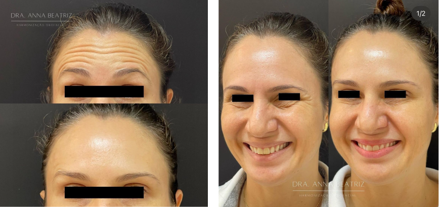 Antes e depois Botox em Fortaleza