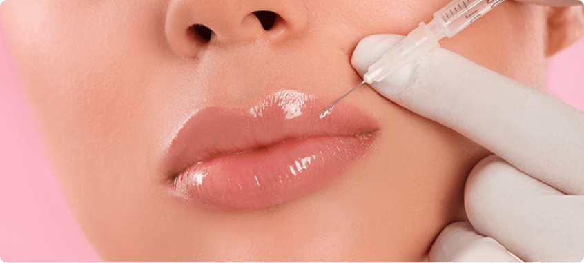 Preenchimento labial na harmonização facial