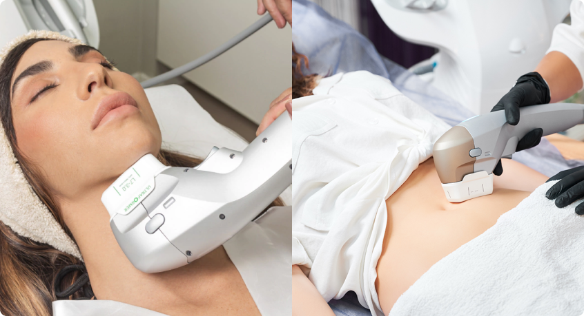 Ultraformer na harmonização facial